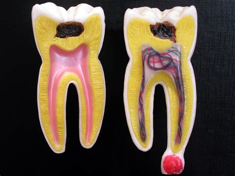 How Does Dental Pulp Get Infected? - Dental Health Society