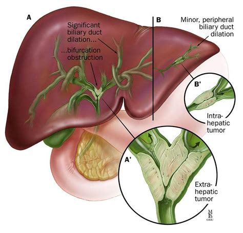 What Causes An Enlarged Bile Duct