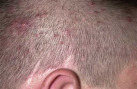 Scalp Ringworm | Med-Health.net