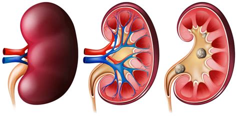 Nephrolithiasis: Causes, Symptoms & Treatment