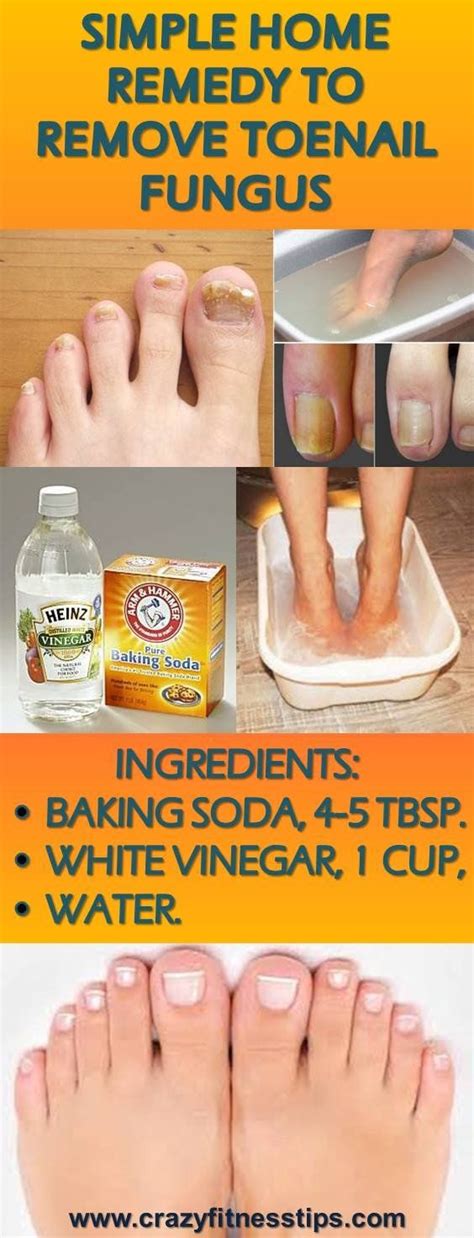 Simple Home Remedy to Remove Toenail Fungus - HEALTH RECIPES