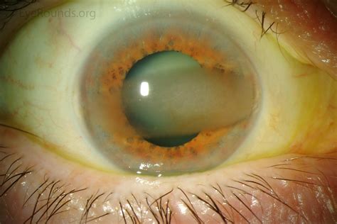 Calcific Band Keratopathy