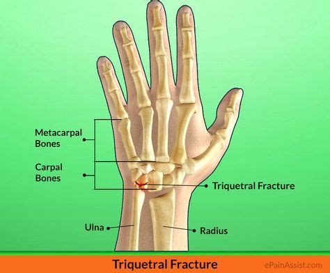 Image result for triquetrum | Wrist injury, Sports injury, Fracture symptoms