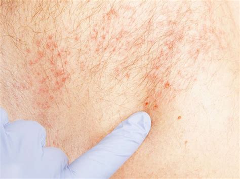 What Is Shingles How It Is Caused And Treatment