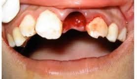 FAMILY CARE DENTAL: DENTAL TRAUMA EMERGENCY--AVULSION OF TOOTH