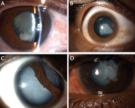 Traumatic Iritis Slit Lamp