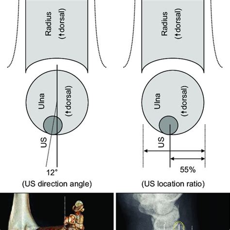 (PDF) Where Is the Ulnar Styloid Process? Identification of the Absolute Location of the Ulnar ...