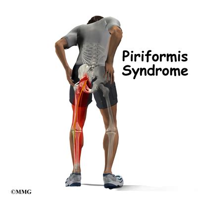 piriformis syndrome - meddic