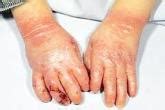 Epidermolysis bullosa