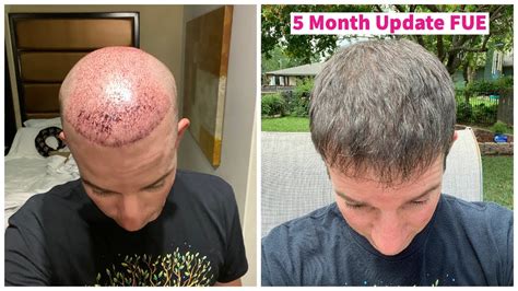 25+ hair transplant 5 months - SanketaLaiton