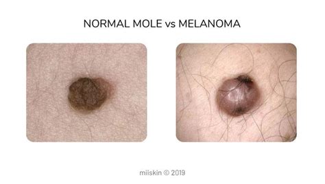 Melanoma Cancerous Moles Images - img-ultra