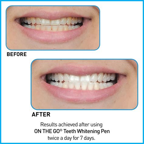 Go Smile Teeth Whitening Pen Amazon - TeethWalls