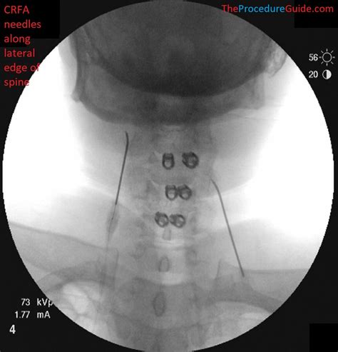 Cervical Medial Branch Block And Radiofrequency Ablation Oblique | The ...