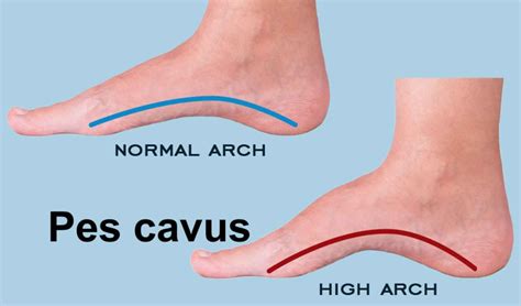 Pes cavus foot definition, causes, symptoms, diagnosis & treatment