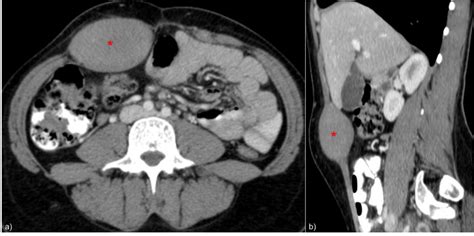 Abdominal wall desmoid-type fibromatosis | Eurorad