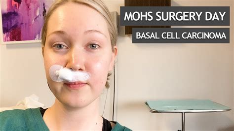 Mohs Surgery Day for Basal Cell Carcinoma - YouTube