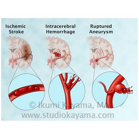 Studio Kayama :Three Types of Stroke - Medical Illustration by Studio Kayama