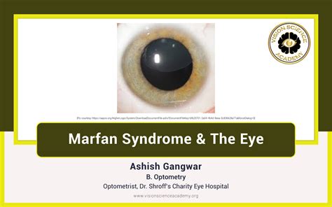 Marfan Syndrome & The Eye - Vision Science Academy