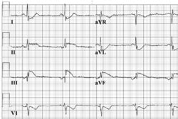 Atrial Rhythm - ECGpedia