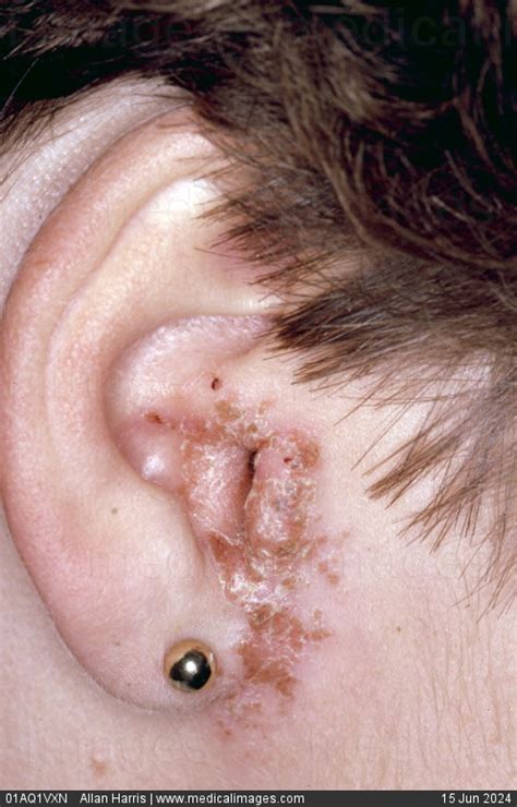 STOCK IMAGE, dermatology fungal otitis externa crusty and peeling skin around the external ear ...