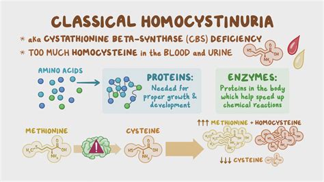 Classical homocystinuria (NORD): Video & Anatomy | Osmosis