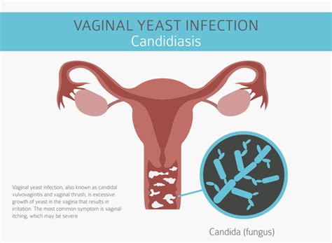 Candida Vaginal Infection