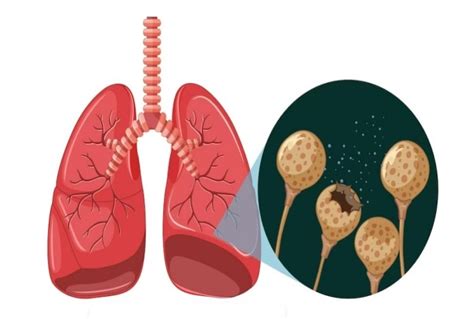 What Is Latent Tuberculosis? Symptoms To Prevention, All You Need To Know