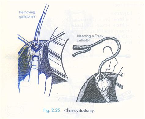 OTMANAGE: PROCEDURE Cholecystostomy