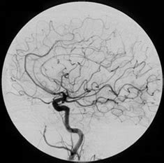 Brain (Carotid Angiogram) - Imaging Glossary - Patients - UR Medicine Imaging Sciences ...