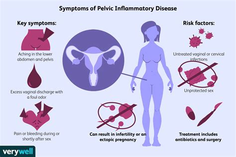 Pelvic Inflammatory Disease (PID) Symptoms, Causes, Risk, 58% OFF