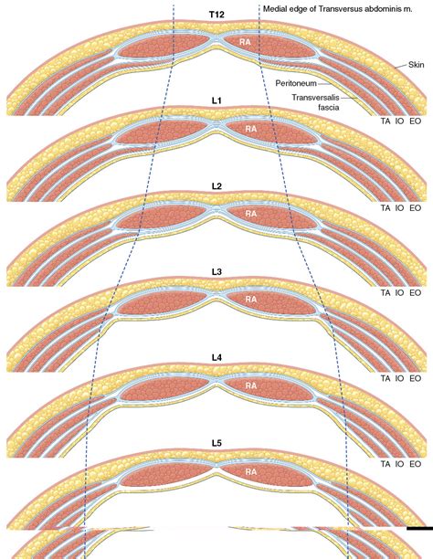 NESPS - Redefining the Rectus Sheath: implications for Abdominal Wall Repair