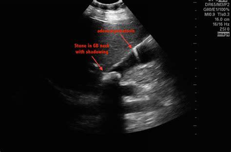 Hennepin Ultrasound | Two Abnormalities in this Gallbladder?