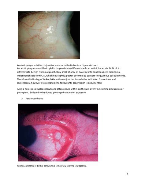 Conjunctival tumors