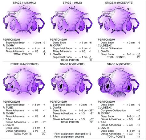 Stages of endometriosis. Source:... | Download Scientific Diagram