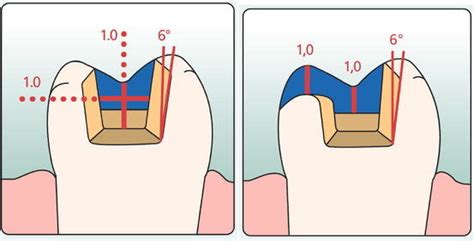 Inlay and onlay preparation guidelines for e.max (printed with... | Download Scientific Diagram