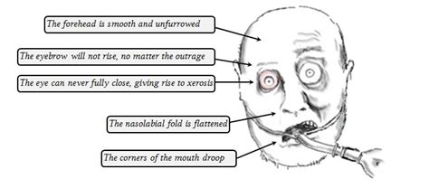 Facial Nerve Lesion