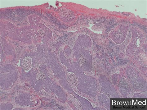 moderately differentiated squamous cell carcinoma - pictures, photos