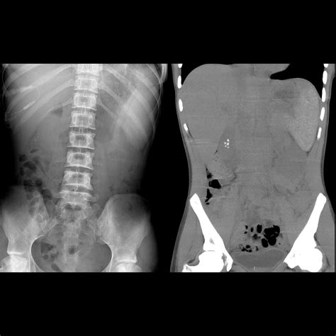 Teenager with sickle cell disease and abdominal pain | Pediatric Radiology Case | Pediatric ...