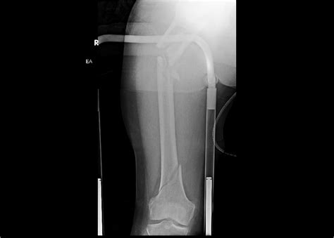 Emergency Perineural Femoral catheter — Highland Emergency Ultrasound