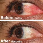 Pterygium Surgery Before & After Photos Monterey Park