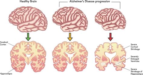 Alzheimer S Stages