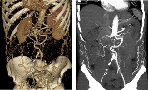 Circumferential Aortic Endarterectomy Followed with Immediate Infrarenal Clamping Obviates ...