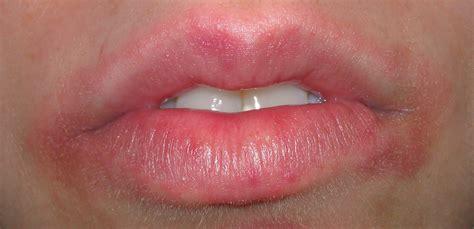 Tips to Reduce Lips Pigmentation | FS Fashionista