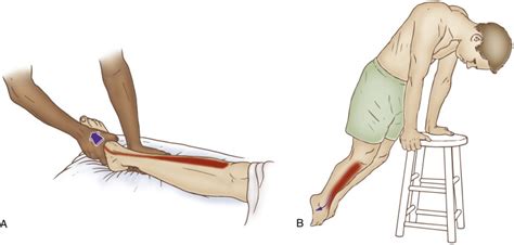 What are Shin splints? causes and treatment of shin splints.