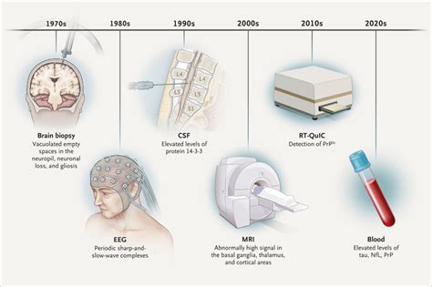 Laboratory Diagnosis of Creutzfeldt–Jakob Disease | NEJM