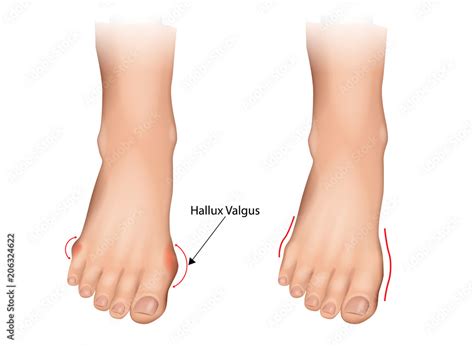 Illustration of the normal foot and hallux valgus. Human foot deformity ...