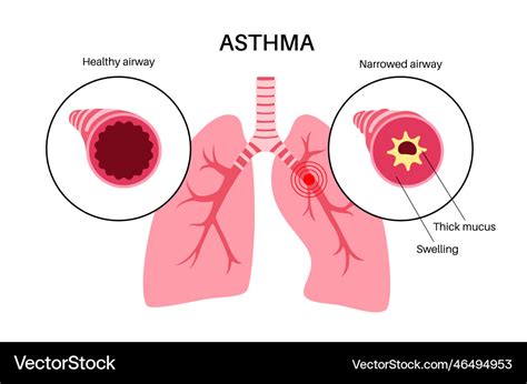 Asthma lung disease Royalty Free Vector Image - VectorStock