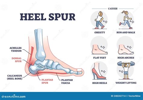 Heel Spur or Calcaneal Bone Condition Causing Pain in Feet Outline Diagram Stock Vector ...