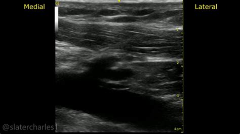 Ultrasound Guided Axillary Vein Access for Cardiac Implantable Devices ...