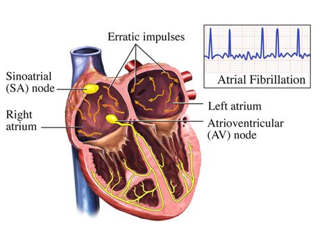 Atrial Fibrillation | NHLBI, NIH